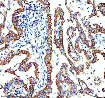 Immunohistochemical staining of TMEM173/STING using anti-STING1 antibody. TMEM173/STING was detected in a paraffin-embedded section of human lung cancer tissue. Heat mediated antigen retrieval was performed in EDTA buffer (pH 8.0, epitope retrieval solution). The tissue section was blocked with 10% goat serum. The tissue section was then incubated with 2 ug/ml rabbit anti-STING1 antibody overnight at 4oC.