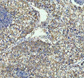 IHC staining of FFPE human lung cancer tissue with TOMM20 antibody. HIER: boil tissue sections in pH8 EDTA for 20 min and allow to cool before testing.