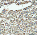 IHC staining of FFPE human liver cancer tissue with ARHGEF12 antibody, HRP-labeled secondary and DAB substrate. HIER: boil tissue sections in pH8 EDTA for 20 min and allow to cool before testing.