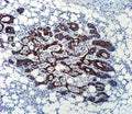 TGFB2 antibody immunohsitochemistry analysis in formalin fixed and paraffin embedded human colon carcinoma