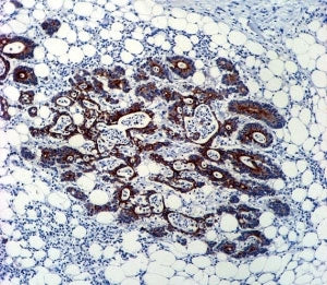 TGFB2 antibody immunohsitochemistry analysis in formalin fixed and paraffin embedded human colon carcinoma