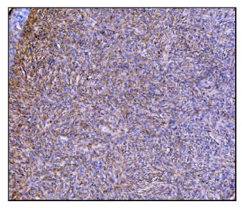 IHC staining of FFPE human skin cancer tissue with Prolyl Endopeptidase antibody. HIER: boil tissue sections in pH8 EDTA for 20 min and allow to cool before testing.