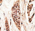 IHC analysis of FFPE human breast carcinoma tissue stained with the TAP1 antibody