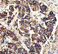 IHC staining of FFPE human colon cancer tissue with CAMK II alpha antibody, HRP-secondary and DAB substrate. HIER: boil tissue sections in pH8 EDTA for 20 min and allow to cool before testing.