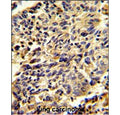 IHC staining of FFPE human lung carcinoma tissue with Glypican-1 antibody. HIER: steam section in pH6 citrate buffer for 20 min and allow to cool prior to staining.