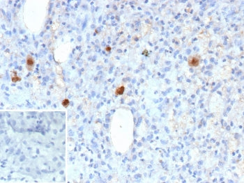 IHC staining of FFPE human CMV-infected tissue with Cytomegalovirus antibody (clone rCMV/9827). Inset: PBS used in place of primary Ab (secondary Ab negative control). HIER: boil tissue sections in pH 9 10mM Tris with 1mM EDTA for 20 min and allow to cool before testing.