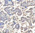 Immunohistochemical staining of ASCL1 using anti-ASCL1 antibody. ASCL1 was detected in a paraffin-embedded section of human lung cancer tissue. Heat mediated antigen retrieval was performed in EDTA buffer (pH 8.0, epitope retrieval solution). The tissue section was blocked with 10% goat serum. The tissue section was then incubated with 2 ug/ml rabbit anti-ASCL1 antibody overnight at 4oC. Peroxidase Conjugated Goat Anti-rabbit IgG was used as secondary antibody and incubated for 30 min at 37oC.
