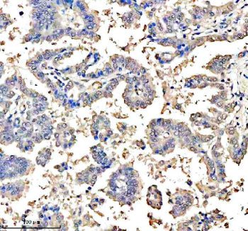 Immunohistochemical staining of ASCL1 using anti-ASCL1 antibody. ASCL1 was detected in a paraffin-embedded section of human lung cancer tissue. Heat mediated antigen retrieval was performed in EDTA buffer (pH 8.0, epitope retrieval solution). The tissue section was blocked with 10% goat serum. The tissue section was then incubated with 2 ug/ml rabbit anti-ASCL1 antibody overnight at 4oC. Peroxidase Conjugated Goat Anti-rabbit IgG was used as secondary antibody and incubated for 30 min at 37oC.