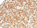 IHC staining of FFPE human kidney carcinoma tissue with Alpha-1-Antitrypsin antibody (clone AAT/4609). HIER: boil tissue sections in pH 9 10mM Tris with 1mM EDTA for 20 min and allow to cool before testing.