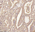 Immunohistochemical staining of PTCD1 using anti-PTCD1 antibody. PTCD1 was detected in a paraffin-embedded section of human breast cancer tissue. Heat mediated antigen retrieval was performed in EDTA buffer (pH 8.0, epitope retrieval solution). The tissue section was blocked with 10% goat serum. The tissue section was then incubated with 2 ug/ml rabbit anti-PTCD1 antibody overnight at 4oC. Peroxidase Conjugated Goat Anti-rabbit IgG was used as secondary antibody and incubated for 30 min at 37oC.