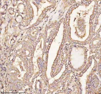 Immunohistochemical staining of PTCD1 using anti-PTCD1 antibody. PTCD1 was detected in a paraffin-embedded section of human breast cancer tissue. Heat mediated antigen retrieval was performed in EDTA buffer (pH 8.0, epitope retrieval solution). The tissue section was blocked with 10% goat serum. The tissue section was then incubated with 2 ug/ml rabbit anti-PTCD1 antibody overnight at 4oC. Peroxidase Conjugated Goat Anti-rabbit IgG was used as secondary antibody and incubated for 30 min at 37oC.