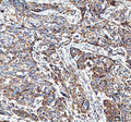 Immunohistochemical staining of FFPE human bladder urothelial carcinoma tissue with MUT antibody, HRP-secondary and DAB substrate. HIER: boil tissue sections in pH8 EDTA for 20 min and allow to cool before testing.