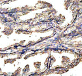 Immunohistochemical staining of GABBR2 using anti-GABBR2 antibody. GABBR2 was detected in a paraffin-embedded section of human prostate cancer tissue. Heat mediated antigen retrieval was performed in EDTA buffer (pH 8.0, epitope retrieval solution). The tissue section was blocked with 10% goat serum. The tissue section was then incubated with 2 ug/ml rabbit anti-GABBR2 antibody overnight at 4oC. Peroxidase Conjugated Goat Anti-rabbit IgG was used as secondary antibody and incubated for 30 min at 37oC.