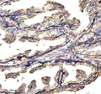 Immunohistochemical staining of GABBR2 using anti-GABBR2 antibody. GABBR2 was detected in a paraffin-embedded section of human prostate cancer tissue. Heat mediated antigen retrieval was performed in EDTA buffer (pH 8.0, epitope retrieval solution). The tissue section was blocked with 10% goat serum. The tissue section was then incubated with 2 ug/ml rabbit anti-GABBR2 antibody overnight at 4oC. Peroxidase Conjugated Goat Anti-rabbit IgG was used as secondary antibody and incubated for 30 min at 37oC.