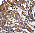 Immunohistochemical staining of RAPH1 using anti-RAPH1 antibody. RAPH1 was detected in a paraffin-embedded section of human breast cancer tissue. Heat mediated antigen retrieval was performed in EDTA buffer (pH 8.0, epitope retrieval solution). The tissue section was blocked with 10% goat serum. The tissue section was then incubated with 2 ug/ml rabbit anti-RAPH1 antibody overnight at 4oC. Peroxidase Conjugated Goat Anti-rabbit IgG was used as secondary antibody and incubated for 30 min at 37oC.