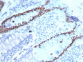 IHC staining of FFPE human colon carcinoma tissue with SATB2 antibody. Strong nuclear staining is observed using clone SATB2/7112 at 2ug/ml. Inset: PBS used in place of primary Ab (secondary Ab negative control). HIER: boil tissue sections in pH 9 10mM Tris with 1mM EDTA for 20 min and allow to cool before testing.