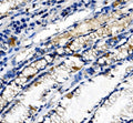 IHC staining of FFPE human gastric cancer tissue with Ghrelin antibody. HIER: boil tissue sections in pH8 EDTA for 20 min and allow to cool before testing.
