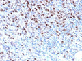 IHC staining of FFPE human melanoma with recombinant MITF antibody. HIER: boil tissue sections in pH 9 10mM Tris with 1mM EDTA for 10-20 min and allow to cool before testing.