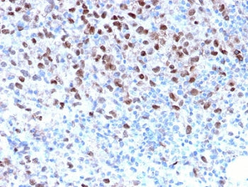 IHC staining of FFPE human melanoma with recombinant MITF antibody. HIER: boil tissue sections in pH 9 10mM Tris with 1mM EDTA for 10-20 min and allow to cool before testing.