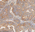 IHC staining of FFPE human ovarian tumor tissue with HDHD5 antibody. HIER: boil tissue sections in pH8 EDTA for 20 min and allow to cool before testing.