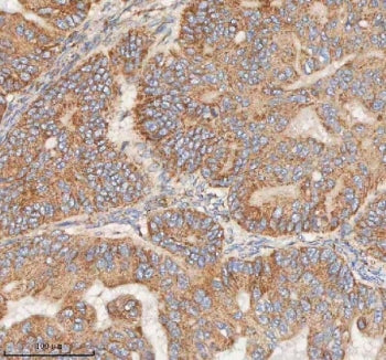 IHC staining of FFPE human ovarian tumor tissue with HDHD5 antibody. HIER: boil tissue sections in pH8 EDTA for 20 min and allow to cool before testing.