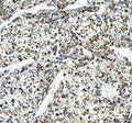 Immunohistochemical staining of FFPE human liver cancer tissue with ALDH2 antibody, HRP-secondary and DAB substrate. HIER: boil tissue sections in pH8 EDTA for 20 min and allow to cool before testing.