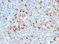 IHC staining of FFPE human Hodgkin's lymphoma with FSCN1 antibody (clone FSCN1/7209). HIER: boil tissue sections in pH 9 10mM Tris with 1mM EDTA for 20 min and allow to cool before testing.