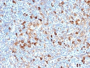 IHC staining of FFPE human Hodgkin's lymphoma with FSCN1 antibody (clone FSCN1/7209). HIER: boil tissue sections in pH 9 10mM Tris with 1mM EDTA for 20 min and allow to cool before testing.