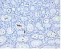IHC staining of FFPE human H. pylori-infected stomach tissue with Helicobacter pylori Catalase antibody (clone HPYL/7171). HIER: boil tissue sections in pH 9 10mM Tris with 1mM EDTA for 20 min and allow to cool before testing.