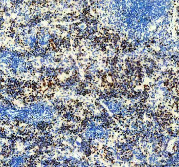 Immunohistochemical staining of Ki67/MKI67 using anti-Ki-67 antibody. Ki67/MKI67 was detected in a paraffin-embedded section of human colon cancer tissue. Heat mediated antigen retrieval was performed in EDTA buffer (pH 8.0, epitope retrieval solution). The tissue section was blocked with 10% goat serum. The tissue section was then incubated with 1:50 rabbit anti-Ki-67 antibody overnight at 4oC. Peroxidase Conjugated Goat Anti-rabbit IgG was used as secondary antibody and incubated for 30 min at 37oC.