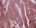 IHC staining of FFPE human urothelial carcinoma tissue with recombinant GATA Binding Protein 3 antibody (clone rGATA3/3870). HIER: boil tissue sections in pH 9 10mM Tris with 1mM EDTA for 20 min and allow to cool before testing.
