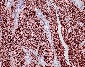 IHC staining of FFPE human urothelial carcinoma tissue with recombinant GATA Binding Protein 3 antibody (clone rGATA3/3870). HIER: boil tissue sections in pH 9 10mM Tris with 1mM EDTA for 20 min and allow to cool before testing.