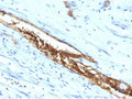 IHC: Formalin-fixed, paraffin-embedded human colon carcinoma stained with Blood Group Antigen A antibody (3-3A)