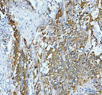 IHC staining of FFPE human bladder infiltrating urothelial carcinoma with squamous differentiation tissue with AGR2 antibody. HIER: boil tissue sections in pH8 EDTA for 20 min and allow to cool before testing.