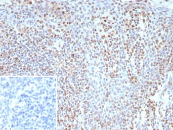 IHC staining of FFPE human tonsil tissue with recombinant Bcl-6 antibody (clone BCL6/9222R). Inset: PBS used in place of primary Ab (secondary Ab negative control). HIER: boil tissue sections in pH 9 10mM Tris with 1mM EDTA for 20 min and allow to cool before testing.