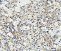 IHC staining of FFPE human liver cancer with ABCB4 antibody. HIER: boil tissue sections in pH8 EDTA buffer for 20 min and allow to cool before testing.