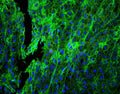 Immunofluorescent staining of FFPE human lung cancer with HLA-C antibody (green) at 1ug/ml and DAPI nuclear stain. HIER: boil tissue sections in pH6, 10mM citrate buffer, for 10-20 min and allow to cool before testing.