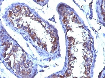 IHC testing of FFPE human testicular carcinoma with Testosterone antibody (clone 4E1G2). Required HIER: boil tissue sections in 10mM citrate buffer, pH 6, for 10-20 min followed by cooling at RT for 20 min.