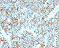 IHC testing of FFPE human Ewing's sarcoma and CD99 antibody (clone CDLA99). Staining of formalin-fixed tissues requires boiling tissue sections in pH 9 10mM Tris with 1mM EDTA for 10-20 min followed by cooling at RT for 20 min.