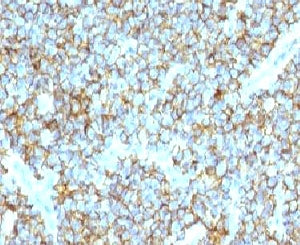 IHC testing of FFPE human Ewing's sarcoma and CD99 antibody (clone CDLA99). Staining of formalin-fixed tissues requires boiling tissue sections in pH 9 10mM Tris with 1mM EDTA for 10-20 min followed by cooling at RT for 20 min.