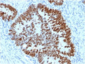 IHC staining of FFPE human colon carcinoma with p53 antibody (clone PCRP-TP53-2A10). HIER: boil tissue sections in pH 9 10mM Tris with 1mM EDTA for 20 min and allow to cool before testing.