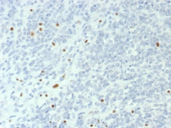 IHC staining of FFPE human ovarian small cell carcinoma with SMARCA4 antibody (clone BRG1/6531R). HIER: boil tissue sections in pH 9 10mM Tris with 1mM EDTA for 20 min and allow to cool before testing.
