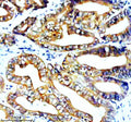 Immunohistochemical staining of STK33 using anti-STK33 antibody. STK33 was detected in a paraffin-embedded section of human colon cancer tissue. Heat mediated antigen retrieval was performed in EDTA buffer (pH 8.0, epitope retrieval solution). The tissue section was blocked with 10% goat serum. The tissue section was then incubated with 2 ug/ml rabbit anti-STK33 antibody overnight at 4oC. Peroxidase Conjugated Goat Anti-rabbit IgG was used as secondary antibody and incubated for 30 min at 37oC.
