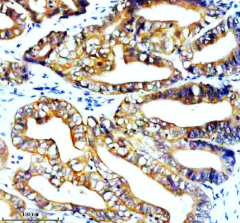 Immunohistochemical staining of STK33 using anti-STK33 antibody. STK33 was detected in a paraffin-embedded section of human colon cancer tissue. Heat mediated antigen retrieval was performed in EDTA buffer (pH 8.0, epitope retrieval solution). The tissue section was blocked with 10% goat serum. The tissue section was then incubated with 2 ug/ml rabbit anti-STK33 antibody overnight at 4oC. Peroxidase Conjugated Goat Anti-rabbit IgG was used as secondary antibody and incubated for 30 min at 37oC.