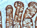 IHC staining of FFPE human colon adenocarcinoma with Villin antibody (clone VIL1/7378R). HIER: boil tissue sections in pH 9 10mM Tris with 1mM EDTA for 20 min and allow to cool before testing.
