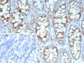 IHC staining of FFPE human colon carcinoma tissue with recombinant Stathmin 1 antibody (clone STMN1/9227R). Inset: PBS used in place of primary Ab (secondary Ab negative control). HIER: boil tissue sections in pH 9 10mM Tris with 1mM EDTA for 20 min and allow to cool before testing.
