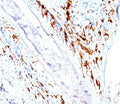 IHC testing of human skin stained with CD1a antibody cocktail (O10 + C1A/711).