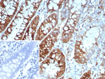IHC staining of FFPE human colon carcinoma tissue with Oncoprotein 18 antibody (clone STMN1/8439). Inset: PBS used in place of primary Ab (secondary Ab negative control).