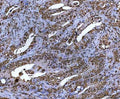 IHC staining of FFPE human colorectal adenocarcinoma tissue with NR5A2 antibody. HIER: boil tissue sections in pH8 EDTA for 20 min and allow to cool before testing.