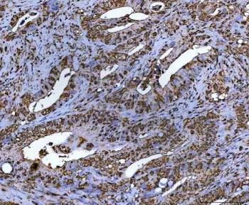IHC staining of FFPE human colorectal adenocarcinoma tissue with NR5A2 antibody. HIER: boil tissue sections in pH8 EDTA for 20 min and allow to cool before testing.